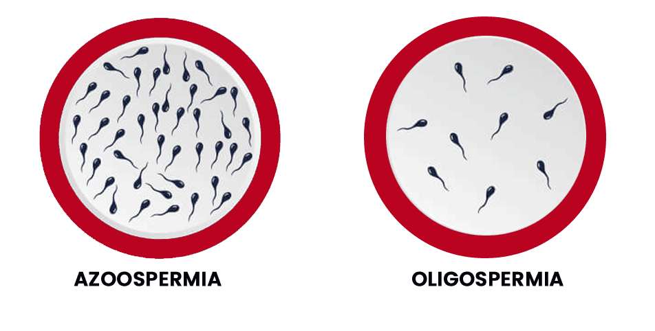 Azoospermia treatment in In Bathinda