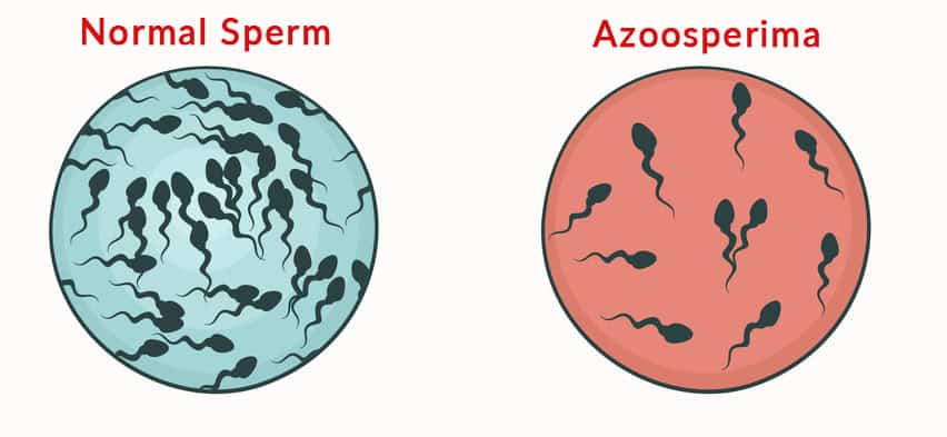 Azoospermia Male Infertility - Gem Hospital and IVF centre