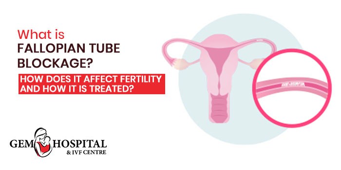 What is fallopian tube blockage How does it affect fertility and how it is treated