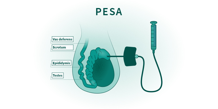 pesa treat